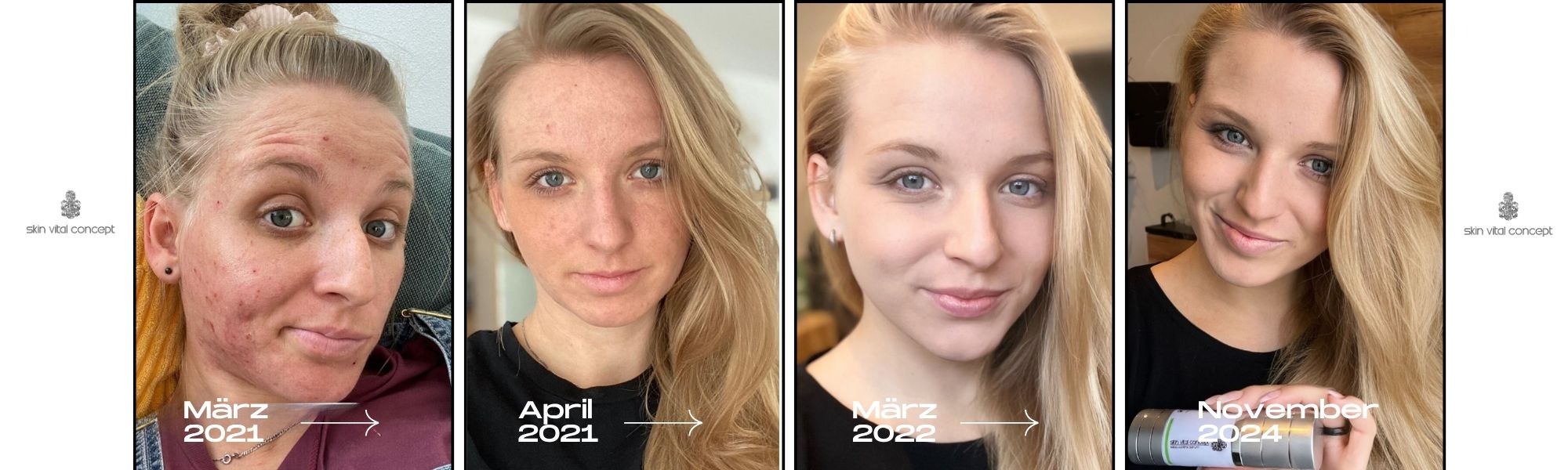 Vier Portraits derselben Frau zeigen ihre Hautveränderung von März 2021 mit starker Akne bis November 2024 mit strahlend klarer Haut – dokumentiert mit Jahresangaben und Skin Vital Concept Produkten.