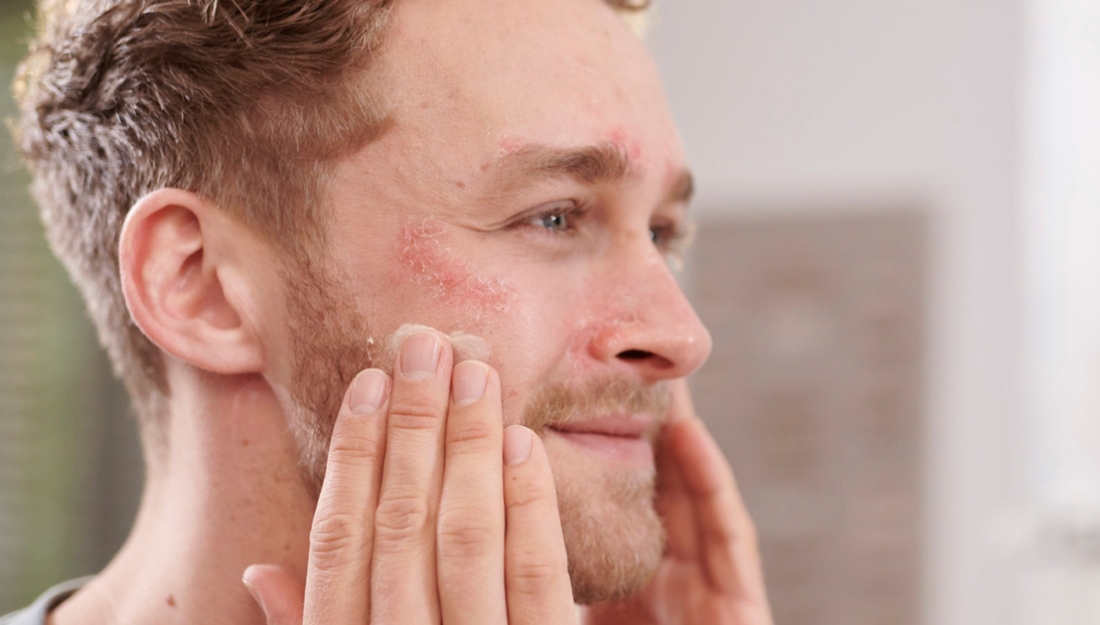 Mann mit Neurodermitis behandelt seine trockene Haut mit den Pflegeprodukten von Skin Vital Concept für empfindliche Haut