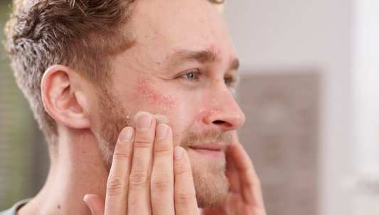 Mann mit Neurodermitis behandelt seine trockene Haut mit den Pflegeprodukten von Skin Vital Concept für empfindliche Haut