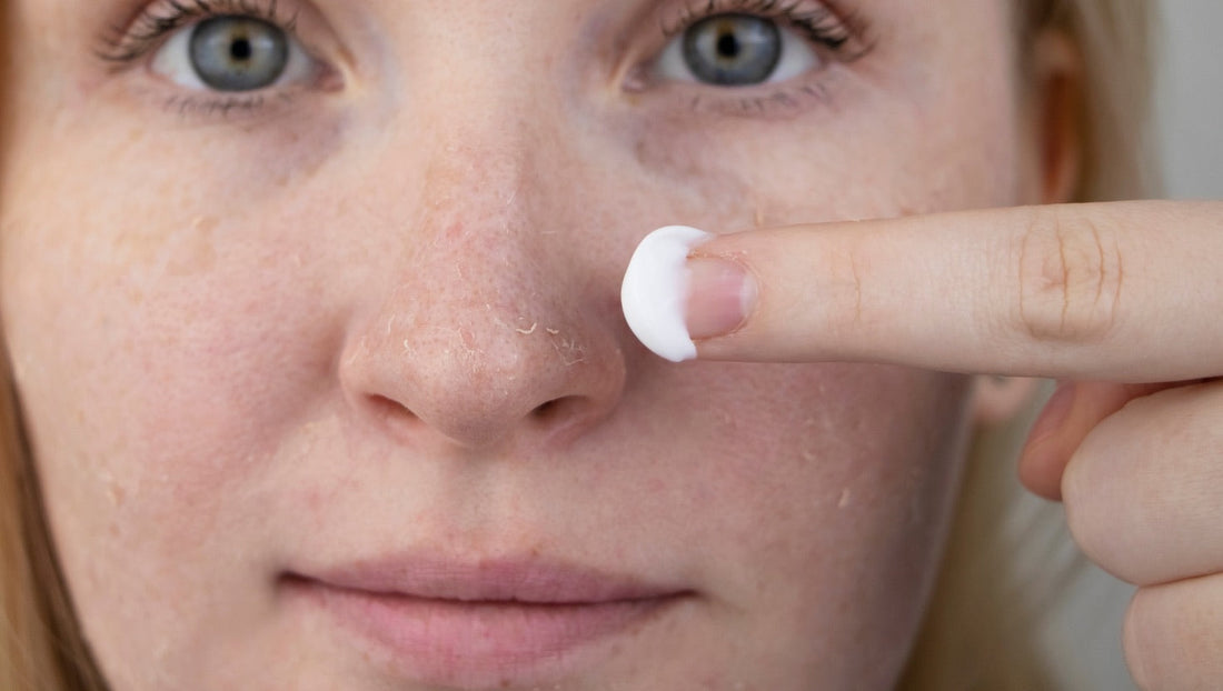Nahaufnahme einer Frau mit trockener, schuppiger Haut im Gesicht – sie trägt eine kleine Menge Creme auf die Nase auf
