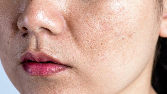Frau mit Pigmentflecken, die die Pflegeprodukte von Skin Vital Concept empfiehlt, gegen empfindliche Haut. Dermatologisch getestet
