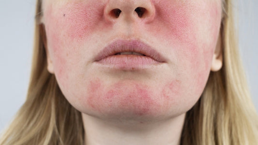 Frau Mit Rosacea empfiehlt Hautpflegeprodukte von Skin Vital Concept für empfindliche Haut, dermatologisch getestet