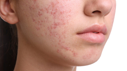 Frau mit Akne empfiehlt Hautpflege von Skin Vital Concept für empfindliche Haut, dermatologisch getestet und natürlich